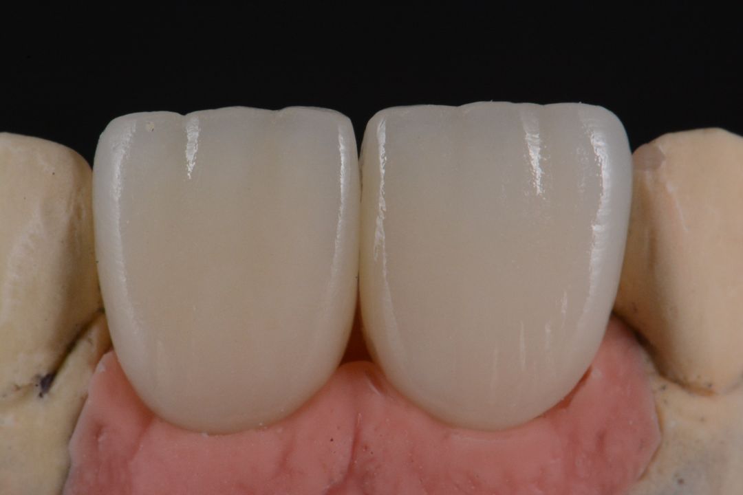 Dental Implants Adelaide