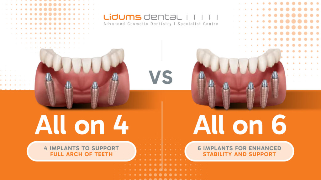All on 4 vs All on 6 Dental Implants: Which Is Right for You? all on 4 all on 6