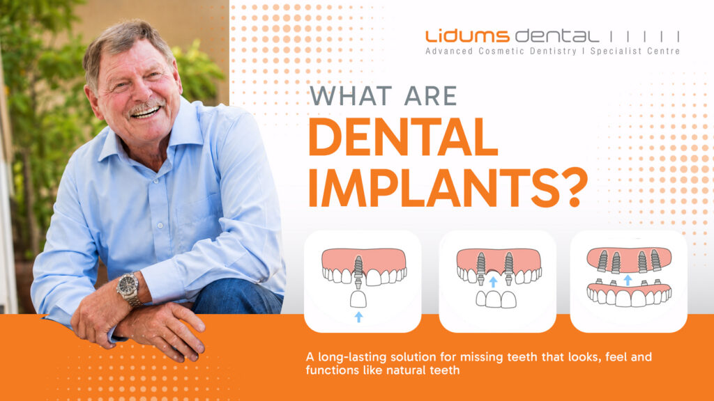 Dentures vs Implants: Which Tooth Replacement Option May Suit You? what are dental implants